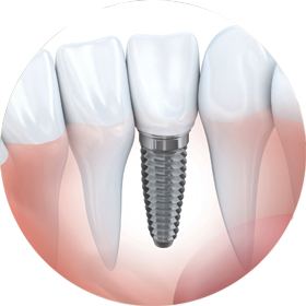 dental-implants